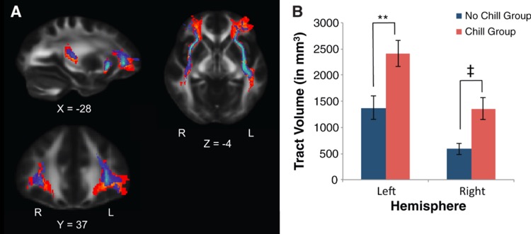 Brain scan showing music-induced goosebumps